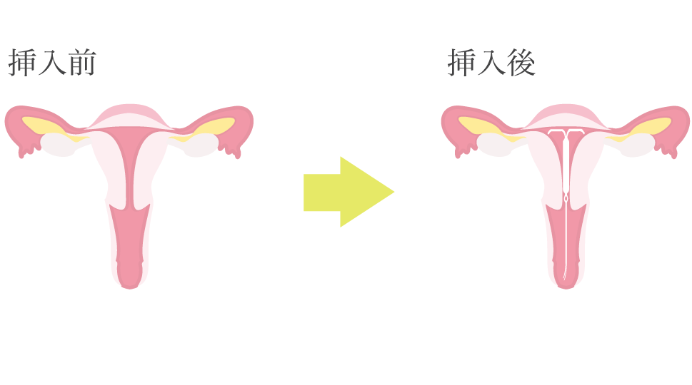 IUDを使用して生活する
